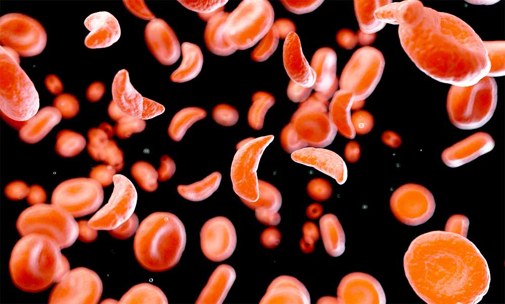 anemija-srpastih-celic